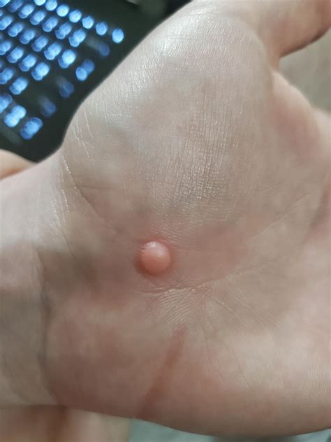 Is this a wart? Painful to put pressure on and didn't react well to