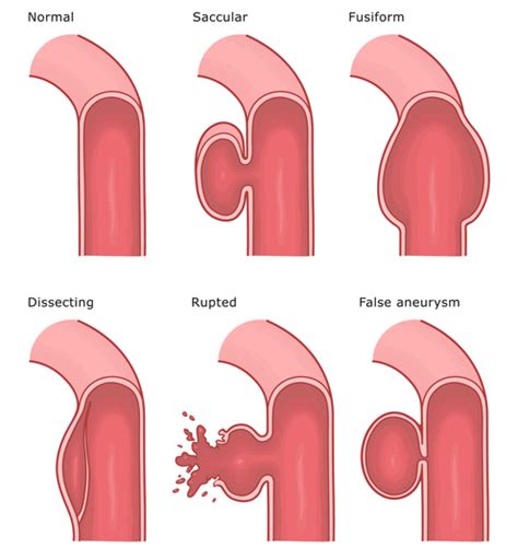 saccular  fusiform aneurysms types risks  treatment options