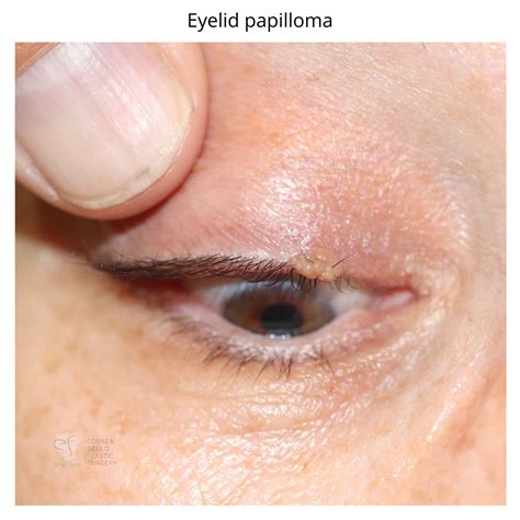 Eyelid papilloma - Dr Anthony Maloof