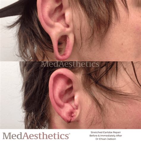 Stretched Earlobe Repair Perth | Torn Earlobes Surgery