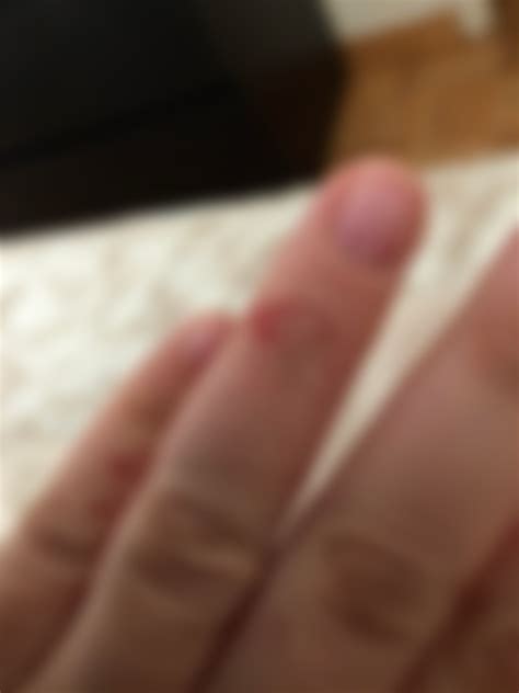how to treat open eczema wounds