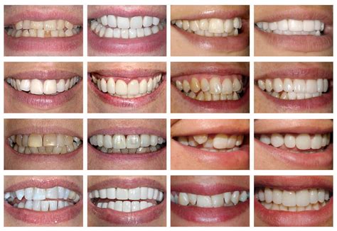 Veneers Before & After & Other Cosmetic Dental Work | The Perfect Smile ...