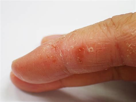 Dyshidrotic Eczema Dyshidrotic Dermatitis
