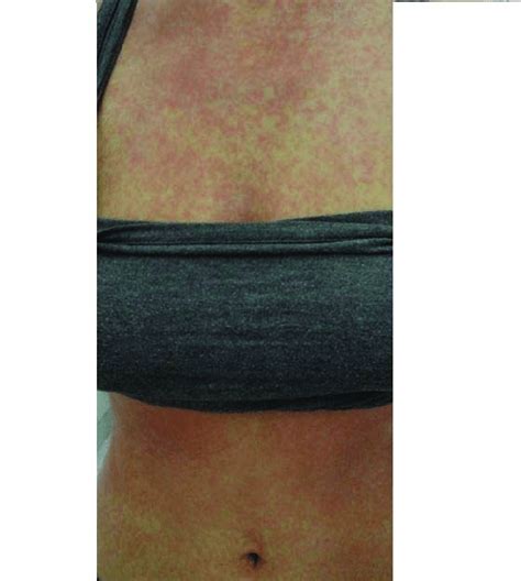 Diffuse exanthematous macular rash on the trunk | Download Scientific