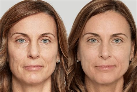 long  sculptra takes effect  sarah lee blog
