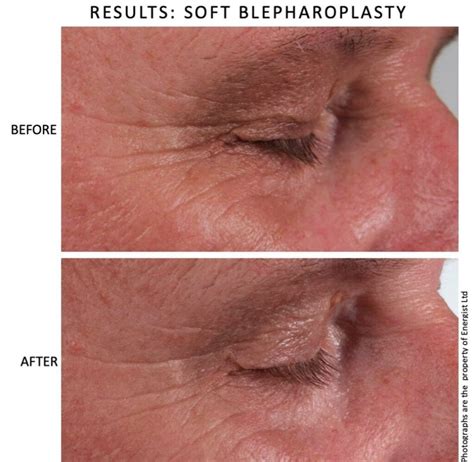 Before & After Gallery – Cincinnati NeoGen Plasma Skin Regeneration