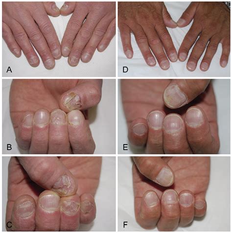 psoriasis nail | hacsaterte1975's Ownd