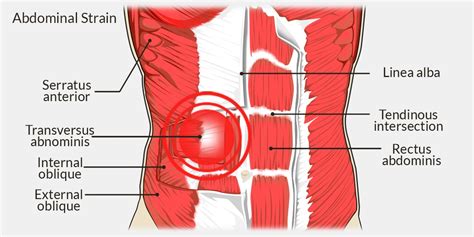 Abdominal Muscle Strain - Symptoms and Treatment - 9INE POINT