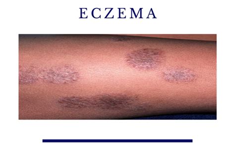 7 Types Of Eczema