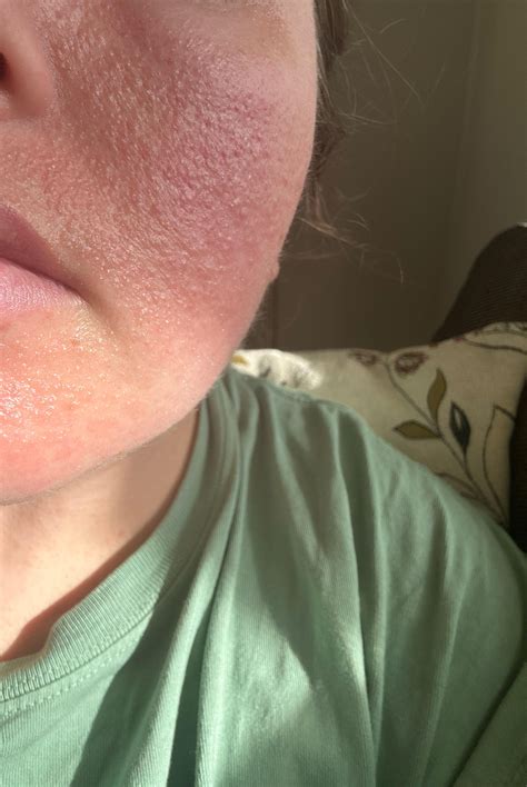 Has anyone else had a bad allergic reaction to pine sol? : r/CleaningTips