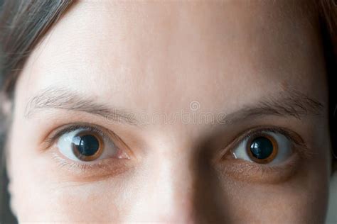 Close-up of a Woman S Brown Eyes with Dilated Big Pupils after Eye ...