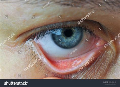 Implementation Drug Conjunctival Sac Instill Eye Stock Photo 1341006140 ...