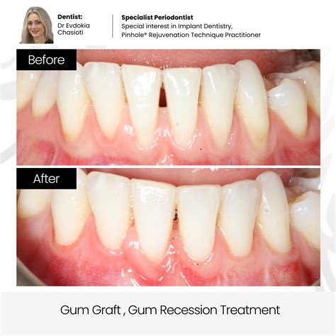 Gingivitis Before And After Treatment Gum Surgery: Receding Gums