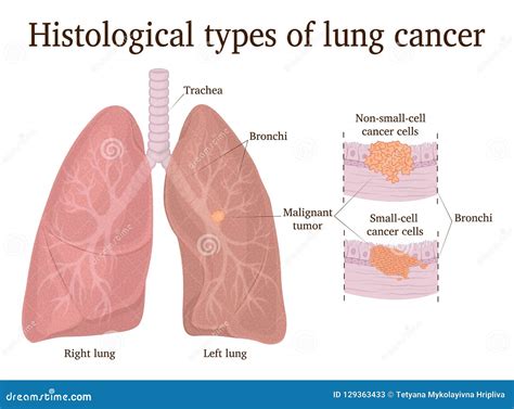 Lung Cancer Cartoons, Illustrations & Vector Stock Images - 189245 ...