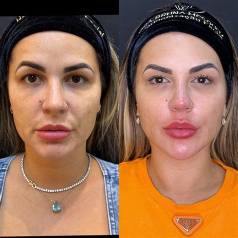 Explante De Silicone Antes E Depois - Segurando próteses de silicone, ex-Tiazinha Suzana Alves tem alta após ...