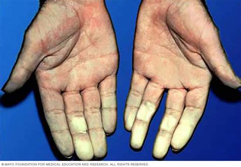 enfermedad de raynaud sintomas  causas