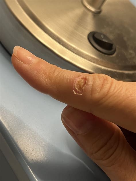 degree burn rwoundcare