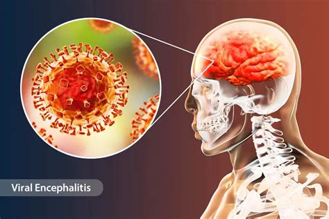 encephalitis  symptoms treatment