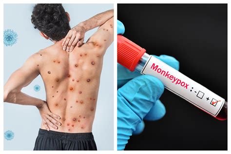 Patient With New Strain of Monkeypox Hospitalized in U.K. - Newsweek 