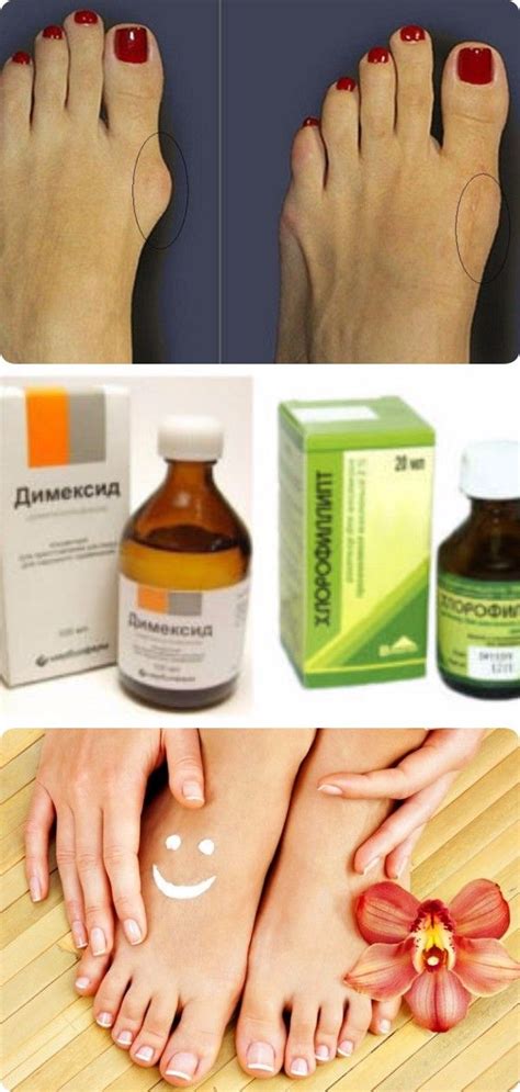Как самостоятельно избавиться от косточки на ноге | Здоровье, Советы ...