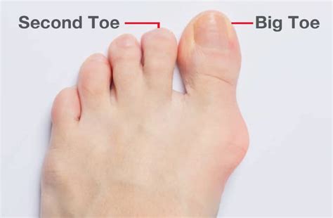 diagnosing  bunion  step
