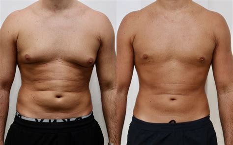 What to Wear After Gynecomastia Surgery: Best Post-Op Recovery Garments ...
