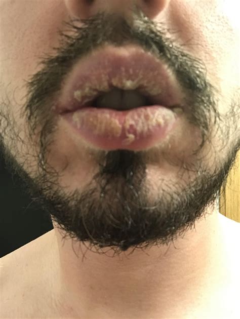 New Treatment Method : r/exfoliativecheilitis