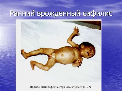 Третичный период сифилиса. Врожденный сифилис - презентация онлайн