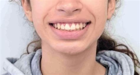 Overbite: Before and After Treatment at BHO