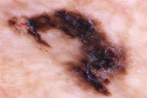 Melanoma Lentiginoso Acral Melanoma Metastatico Melanoma Lentiginoso