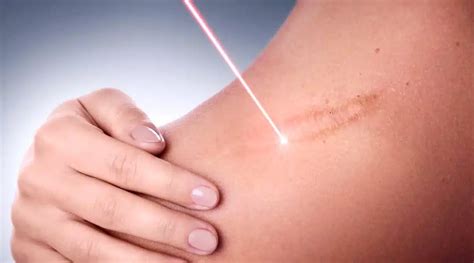 Keloid Treatment New Insights From Studying Keloid Scars Could Provide