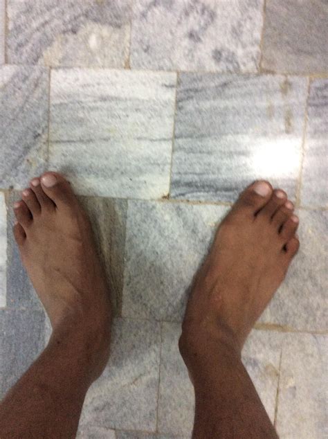 I have flat feet which which point outwards. Is this a serious problem