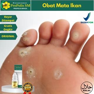 Jual Obat Perontok Mata Ikan, Obat Penghilang Mata Ikan di Telapak Kaki ...