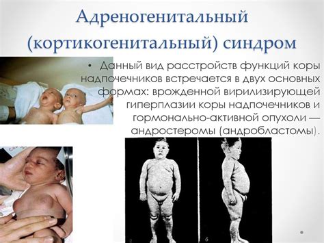 Гиперкортицизм - презентация онлайн