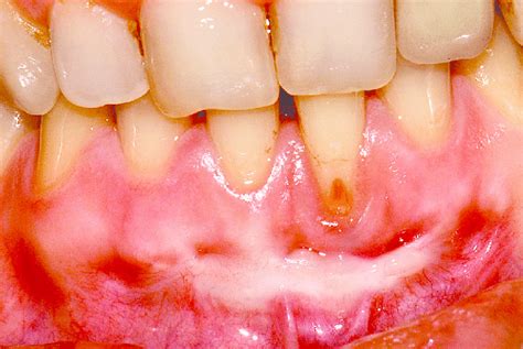 months   surgery  root caries