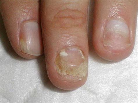 toenail fungus photo     stages micinorm
