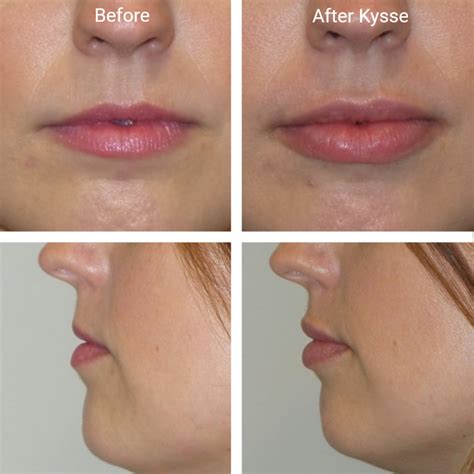 Restylane Kysse Lip Filler Before And After - Infoupdate.org