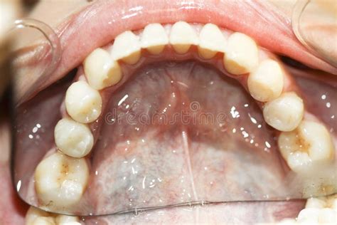 open mouth  dental opener stock photo image  woman dentistry