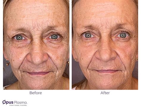 Everything You Need To Know About The Opus Plasma Skin Resurfacing Treatment!