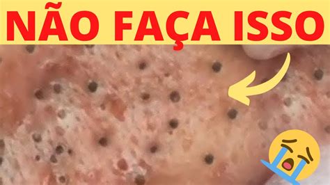 Vídeo De Cravos E Espinhas Recentes