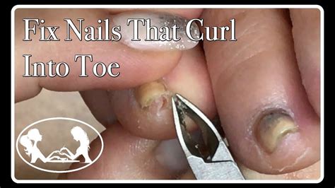 how to fix curling toenails