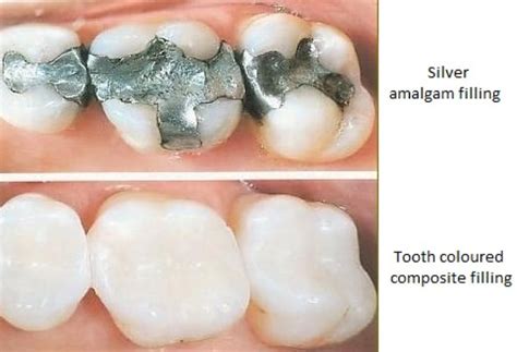 Composite vs. Metal Fillings | Chandler Dental Center | San Antonio, TX