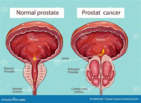 Prostatic Hypertrophy Vector Illustration | CartoonDealer.com #92093348