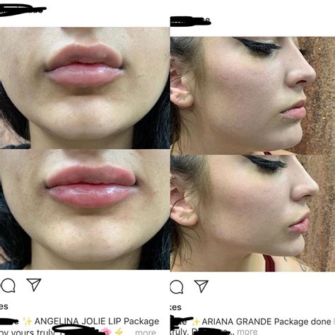 face fillers gone wrong 4