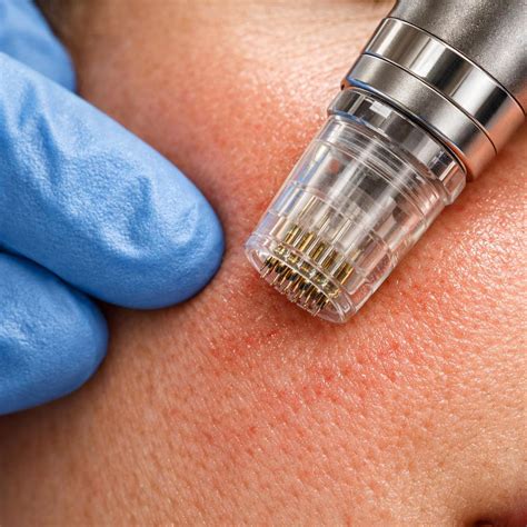 microneedling downtime guide whats normal  treatment