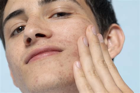 cara menghilangkan bintik di tangan 8