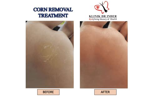 Corn Removal - Laser Treatment - Aesthetic Clinic- Klinik Dr Inder