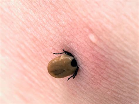 Tick-borne diseases are back. Here's the best way to check for tick