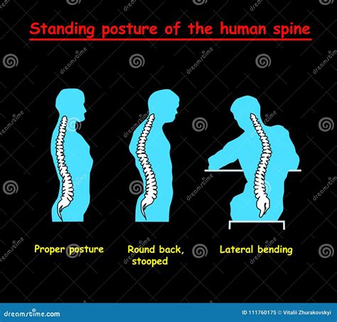 Standing Posture of the Blue Human Spine. Defects of the Human Spine