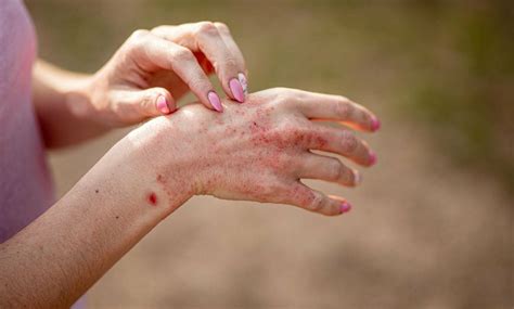 simple picor  dermatitis atopica como diferenciar